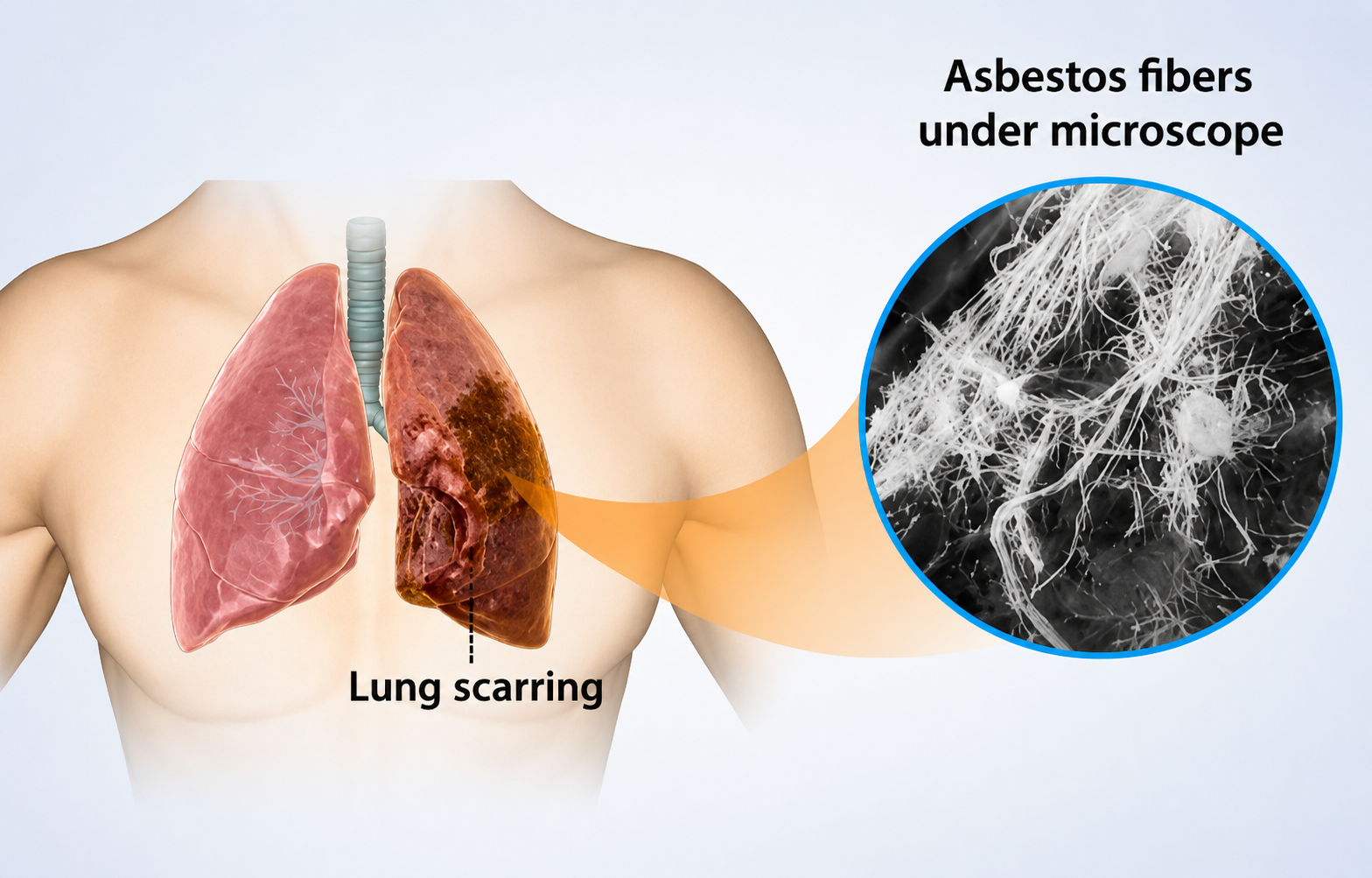 Asbestos Commerce in India: An Unresolved Trade and Its Unacknowledged Disease Burden